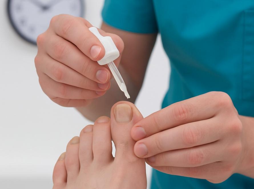 Toenail Fungus (Onychomycosis) Treatment